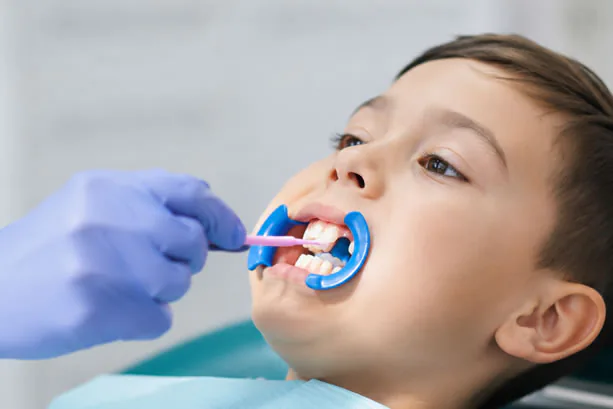 Dental sealants applied to teeth at Caln Family Dental