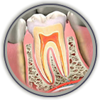 Root Canal Treatment Thorndale